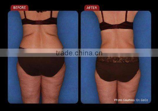 new inventions 2017 650nm laser diode 980nm /i lipo machines for sale