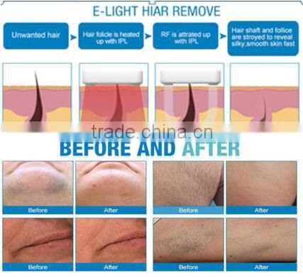 Permanent all body unwanted Hair Remover 808nm diode laser portable equipment