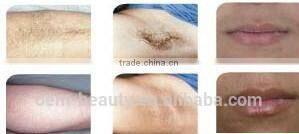 high power laser diode painless hair removal machine for salon/spa/clinic