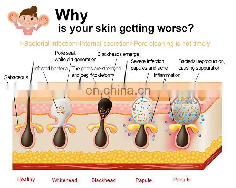 2019 Hot Sale Acne Pimples Removing Blackhead Extractor With Water Round