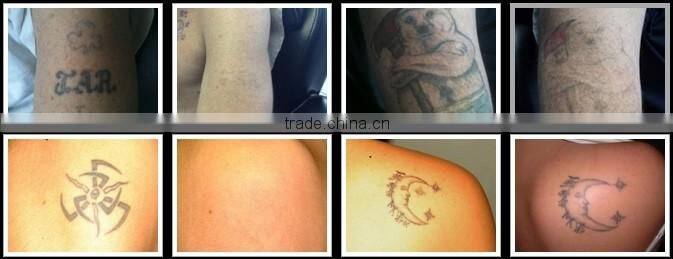 Manufacturer supply!!!! cheapest q switch nd yag laser tattoo removal system