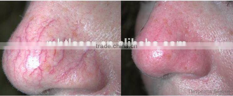 MBT 980nm diode laser for vascular lesions and spider veins machine