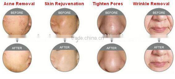 RF Fractional CO2 medical laser from China professional manufacturer for skin renew and medical vaginal care doctors clinic