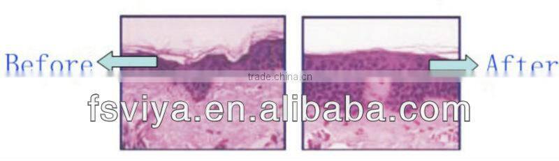 VY-QF8 Popular radio frequency facial machine for skin tightening