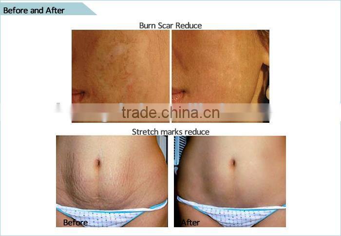 dts 192 needles derma roller