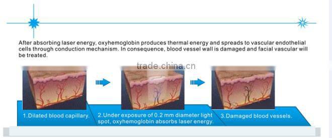 New arrival!!!High frequency 980 diode laser Portable Spider vein/vascular/blood vessels removal machine with Ce approved