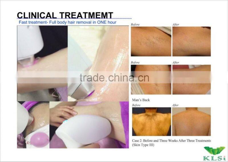 Overseas distributor wanted 808nm diode laser hair removal machine permanent hair removal