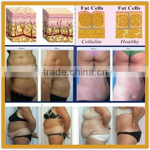 VY-M7 Hotsale Ultra Cavi Lipo Machine