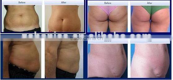 5 in 1 ultrasonic vacuum rf cavitation fat cutting BS08