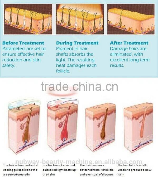 FDA Approved Laser Hair Removal Machine IPL With RF Israel