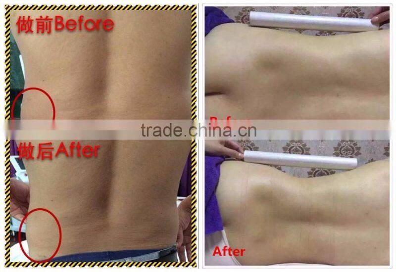 2016 liposonix hifu slimming equipment / liposonix LANGDI ORIGINAL FACTORY