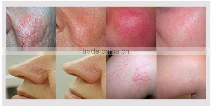 Professional Spider Vein GSD Professional High-frequency laser vascular removal