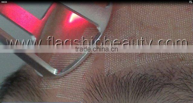 rf co2 fractional laser scar removal stretch mark removal