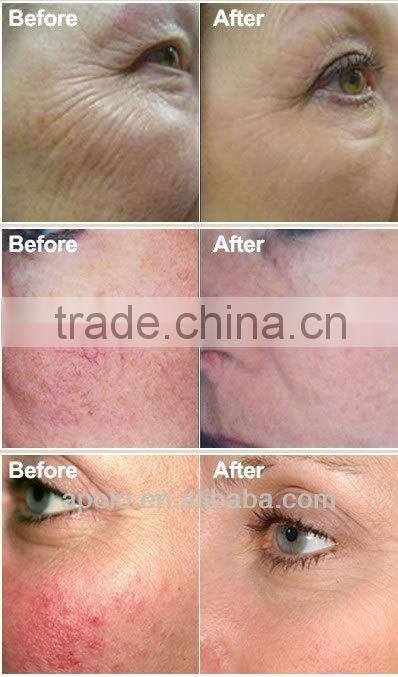 long pulsed nd yag HS 280 varicose veins laser treatment machine by shanghai med apolo medical tech