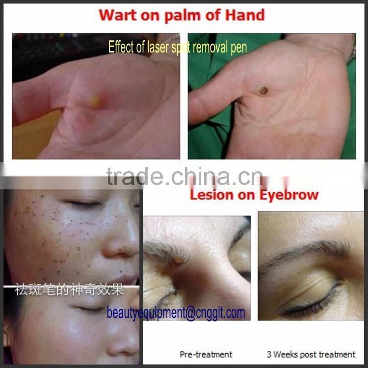 2016 New Freckle Spot Mole Removel laser pen beauty skin laser pen