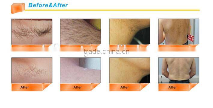 Hair Removal Laser Machines 808nm diode laser