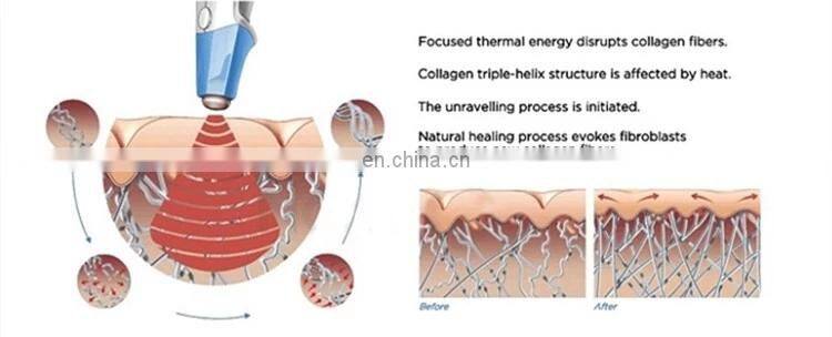 2 in 1 Vacuum cavitation system fat cutting Ultrasound RF weight loss machine