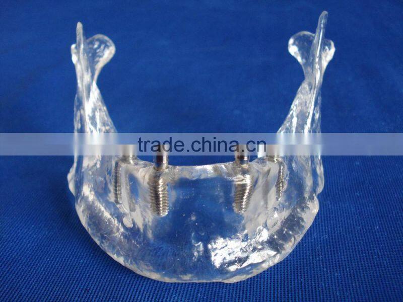 Hot Sale Transparant Mandibule Implant Model