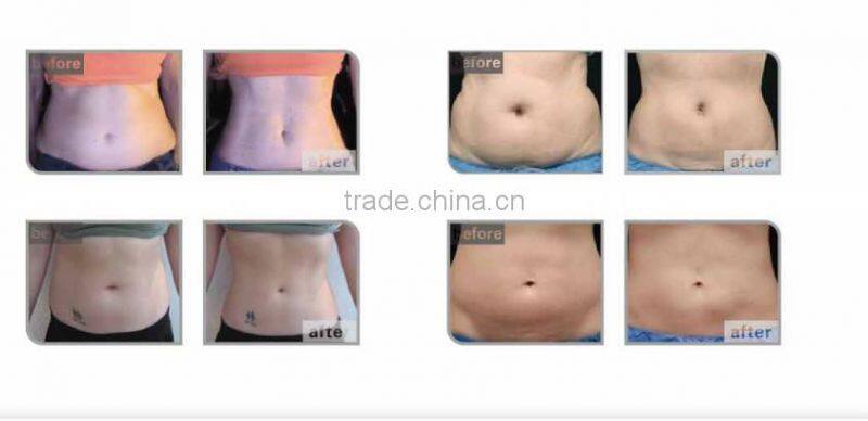 China new designed body shape slimming system hifu transducer