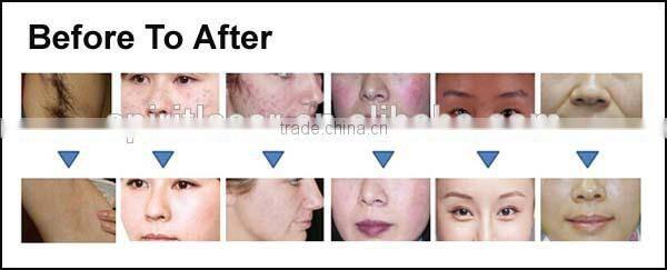 IE-11 Spiritlaser fda approved ipl laser nd yag q-switched