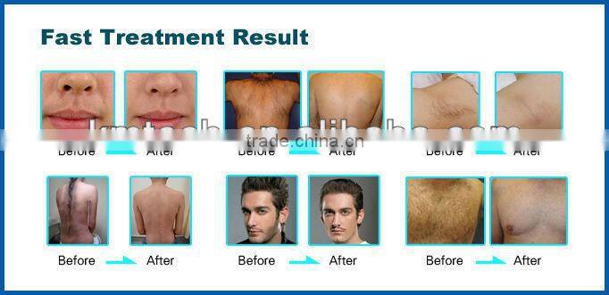 Newest Arrival and hot sale! ipl photo rejuvenation machine