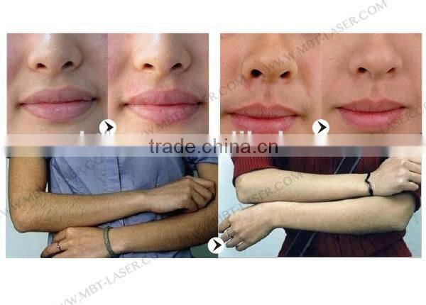 Professional IPL + RF Painfree for E-light Hair Remova Machine