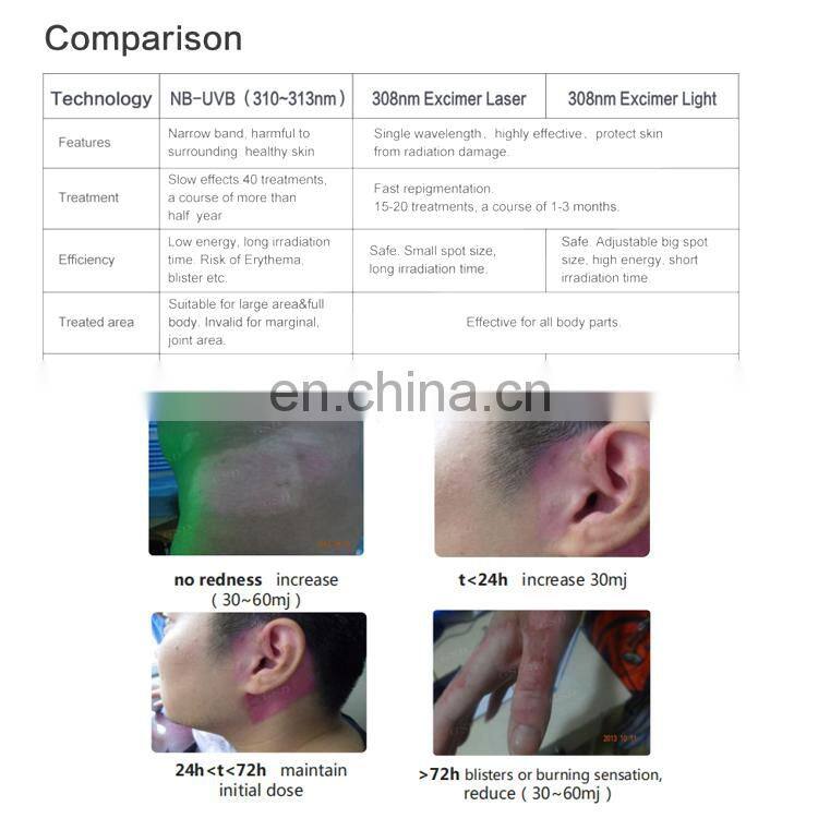 Sales 308nm 310nm uv led/led 308nm/excimer laser 308nm psoriasis vitiligo laser uv lamp