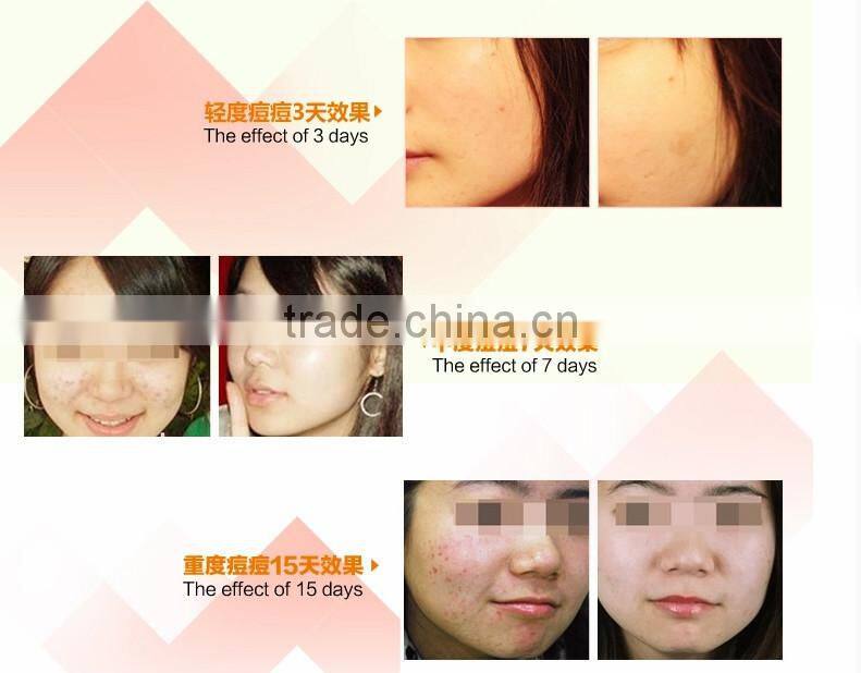 NEWEST! Face Whitening Acne scar Treatment and Pimple Removal Cream
