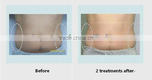 2015 portable&home use cavitation slimming system