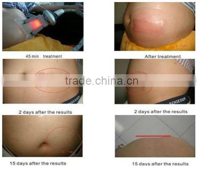 4 finctions in one mode 5 handles double chin fat reduction machine for sale