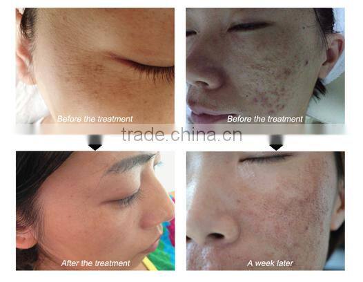 YWF-2 SKINSHAPER rf fractional laser system