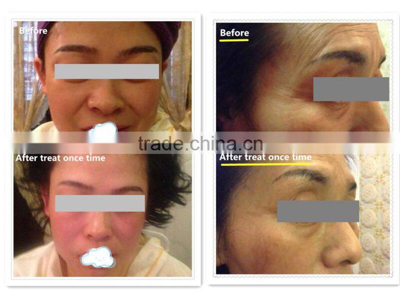 NL-TM800 2015 BEST! fractional rf microneedle mesotherapy machine for sale (CE)