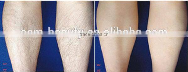 Jiatailonghe salon use nd yag laser hair removal machine for beaury salon use