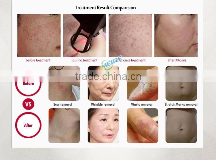 Big discount co2 laser beauty equipment