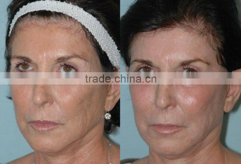 40W China most Professional skin analyzing co2 fractional laser