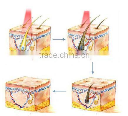 best IPL infrared laser e light beauty equipment hair scan laser