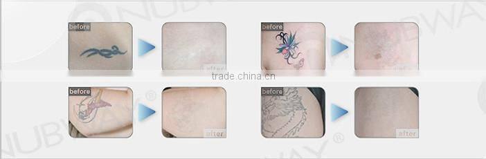High frequency tattoo removal machines for sale