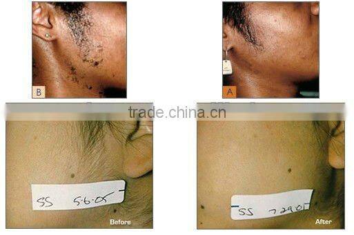 Optimal Pulse Technology Permanent Hair Reduction E-light C001