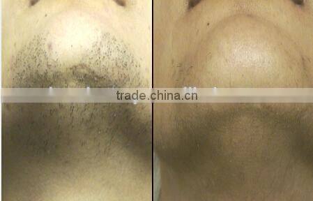 SHR LASER HAIR REMOVAL FOR BEAUTY SALON
