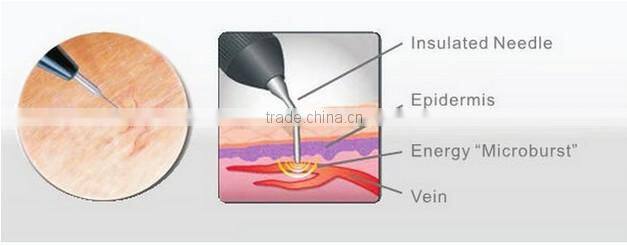 RBS03 CE approved 980nm diode laser for spider veins removal blood vessels removal machine