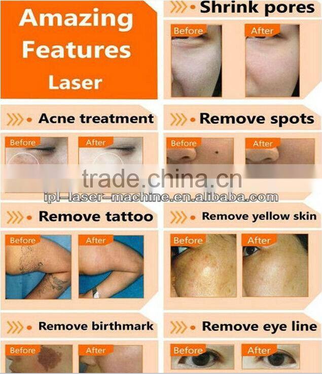 Hot selling!! professional Acne removal laser 532 1064 nd yag q switched
