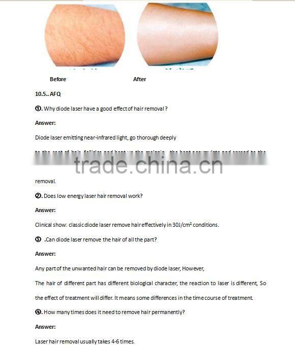 Newest Design Laser Hair Removal Machine For Dark Skin