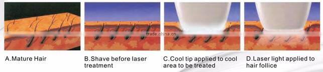Customer favored hair loss 808nm diode laser machine