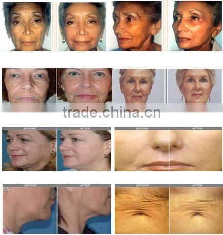 Portable Radio Frequency Beauty Slimming Machine For Facial