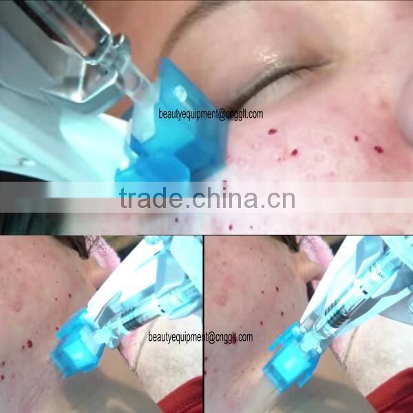 Mesotherapy machine wrinkle remover