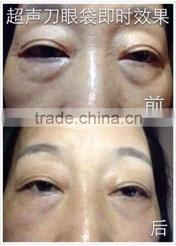 Home use Ultra lift HIFU korea