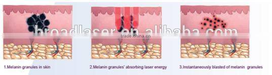 Best q-switched nd yag laser tattoo pigment removal equipment /q-switched laser skin rejuvenation machine