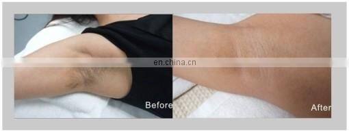 GSD Star product!!! Ipl and professional hair removal beauty machine with CE