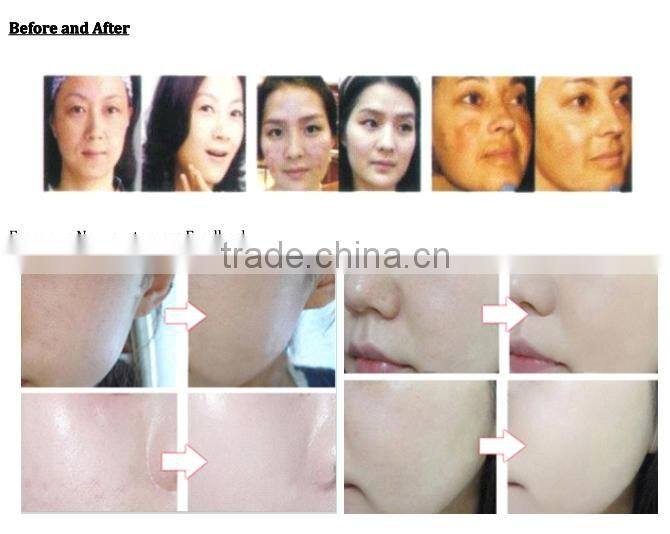 Face treatment LED mask