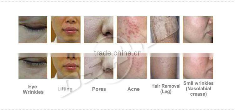 Fast And Efficient 800w Laser Hair Removal Machine Shr Ipl Opt Diode Laser